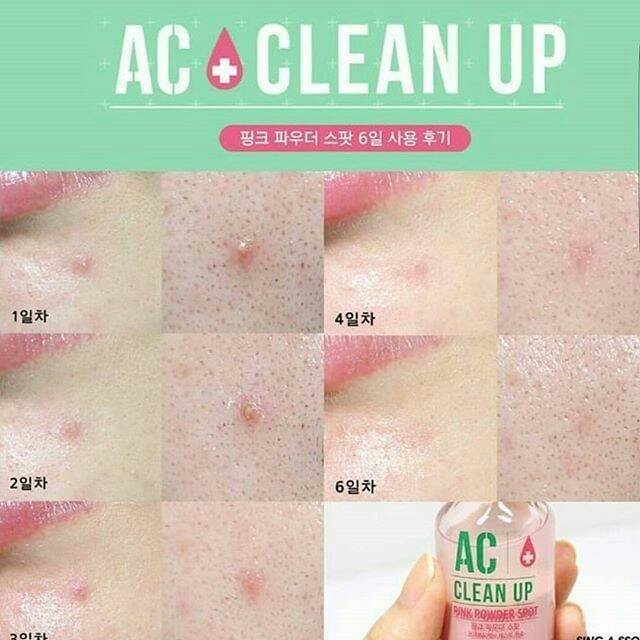 ETUDE HOUSE AC Clean Up Pink Powder Spot 15 ml แป้งน้ำแต้มสิวสูตรใหม่ มีสารบำรุงเข้มข้น ใช้แต้มบนสิว ช่วยลดการอักเสบ ลดปัญหาการอักเสบแดงของสิวได้อย่างรวดเร็ว ไม่ทิ้งรอยดำ  คงความชุมชื้น ช่วยกระชับรูขุมขน ลดรอยแผลอันมีสาเหตุมาจากสิว หลุมสิวหรือแผลอักเสบจะยุบลงอย่างเห็นได้ชัด ไม่มีสารที่ก่อให้เกิดอาการแพ้หรือระคายเคือง